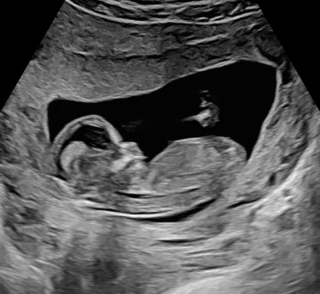 Week 14 ultrasound