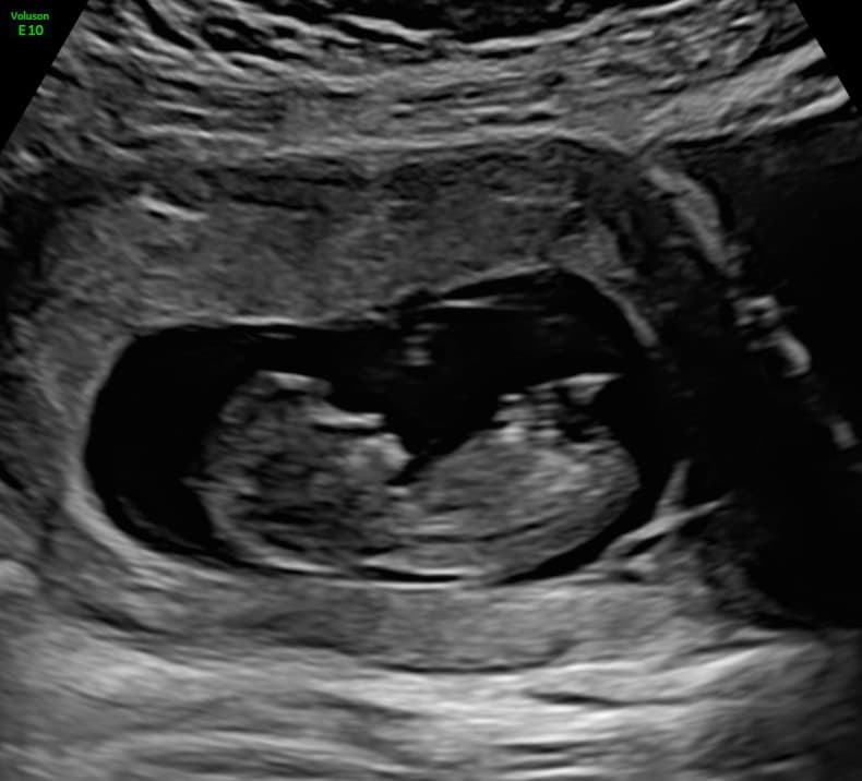 Week 11 ultrasound