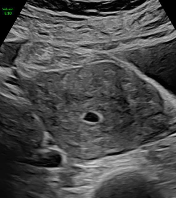 Week 5 ultrasound