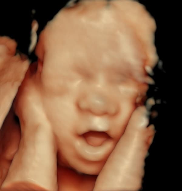 5D HD ultrasound of baby yawning with both hands on cheeks