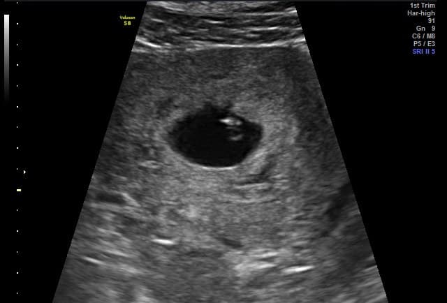 Video Prenatal First Peek / Peace of Mind